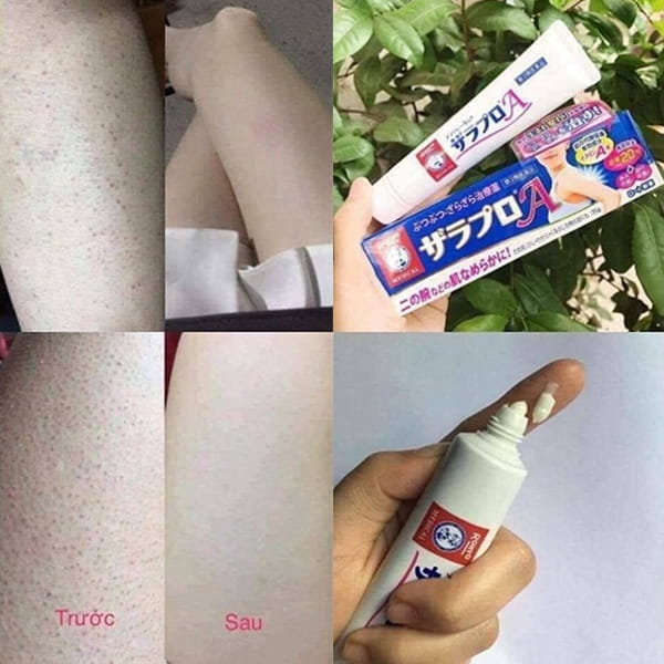 Kem trị viêm nang lông Zaraporo Rohto